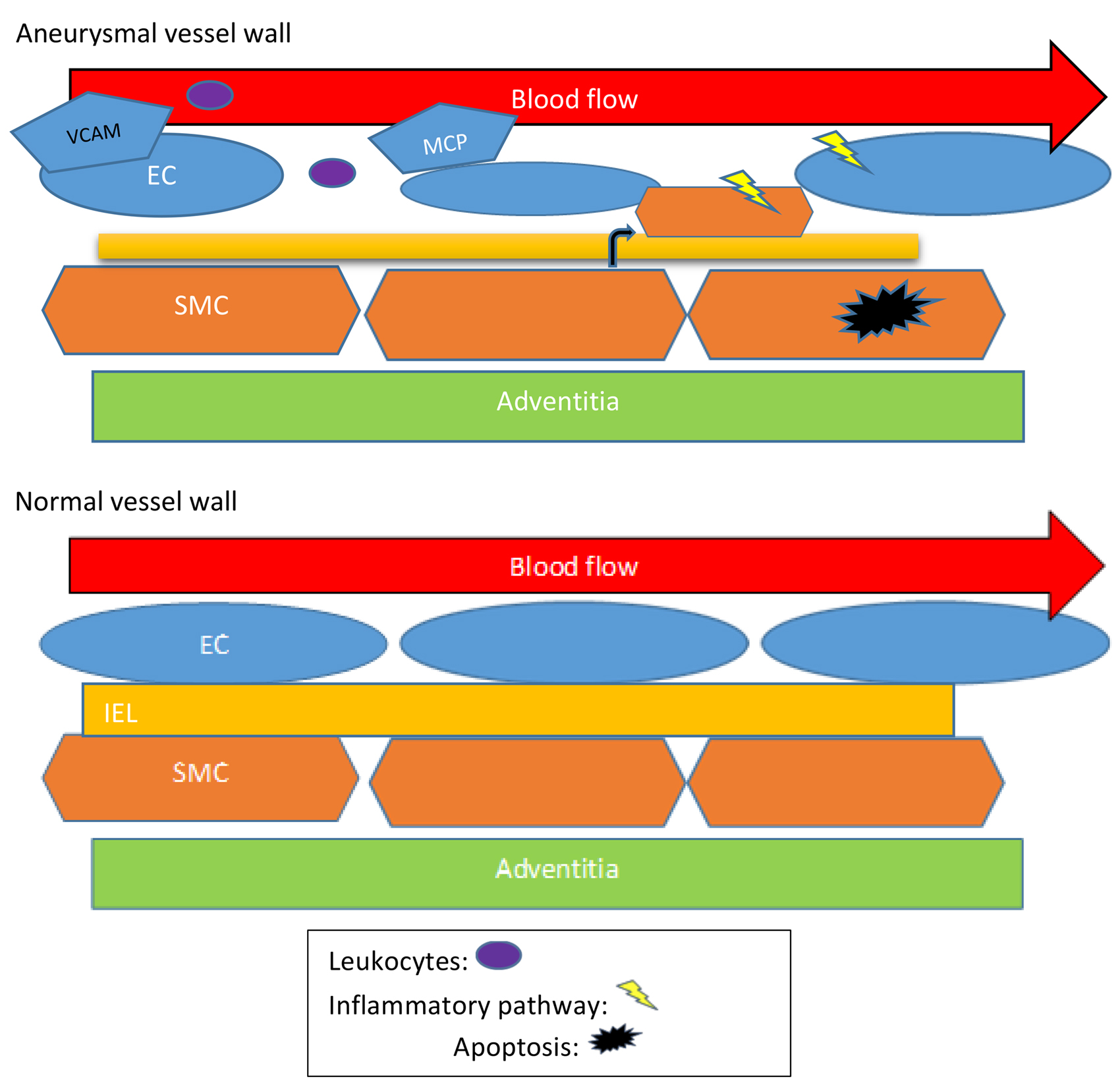 剪切應(yīng)力與動脈瘤：綜述